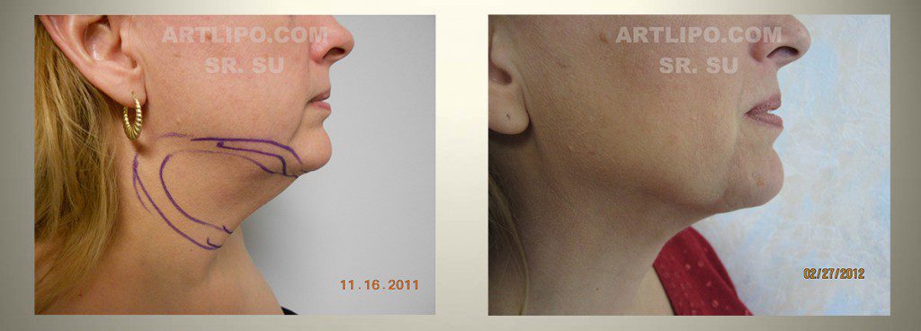 neck lipo - before/after