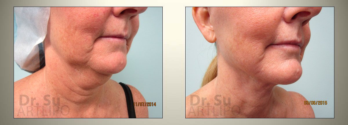 before and after image