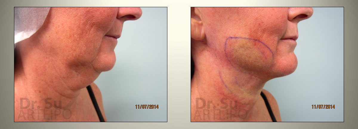 Face Lift Liposuction 
