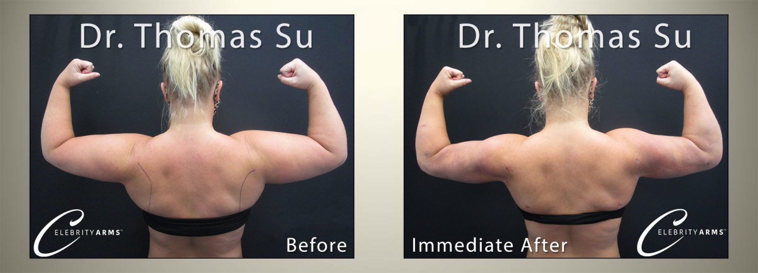 Arm-Liposuction-Lipo360Arms-Lift-High-Definition-Arms-Tampa-Florida-USA2-1536x553 Arm-Liposuction-Lipo360Arms-Lift-High-Definition-Arms-Tampa-Florida-USA2-1536x553