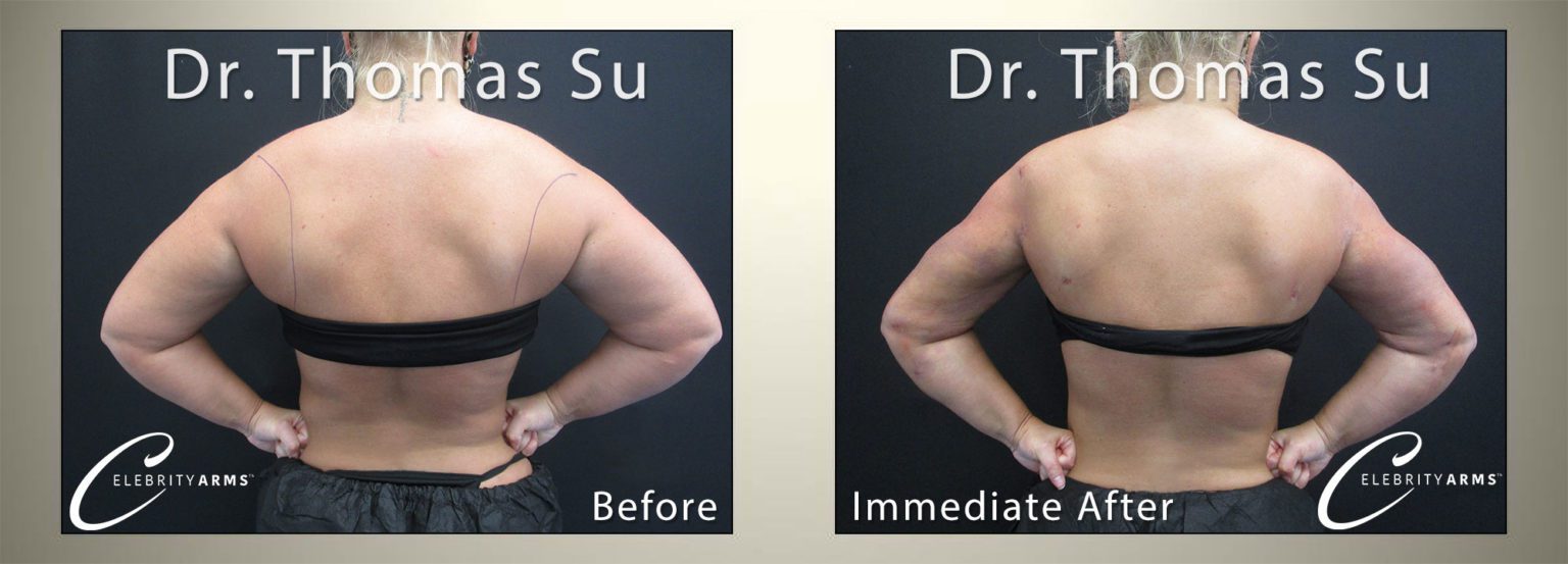 Arm-Liposuction-Lipo360Arms-Lift-High-Definition-Arms-Tampa-Florida-USA6-1536x553
