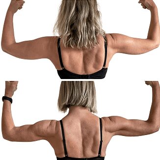 Before and After Arm Lipo Results