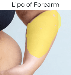 Lipo of Fore Arm