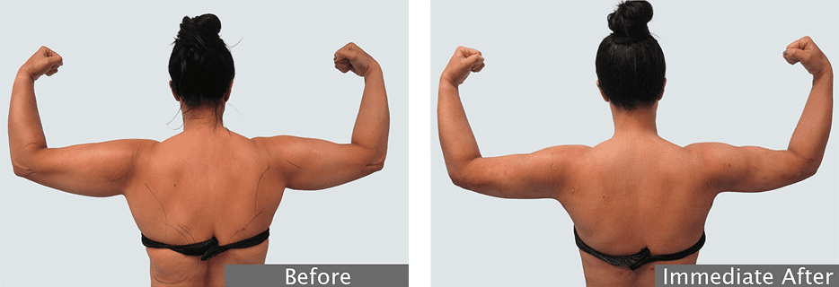 Skin Tightening Results Immediate After