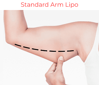 Standard Arm Lipo